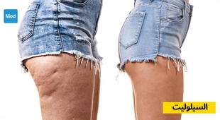 Magazine السيلوليت