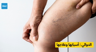 Magazine الدوالي : أسبابها وعلاجها