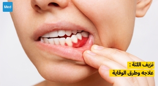 Magazine نزيف اللثة: كيفية التعامل معه والوقاية منه