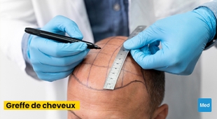 Magazine La Greffe de Cheveux : Restaurer la Beauté Naturelle et la Confiance en Soi