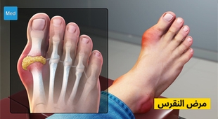 Magazine مرض النقرس
