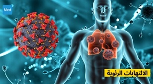 Makaleler الالتهابات الرئوية