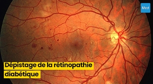Magazine L'Importance du Dépistage Précoce de la Rétinopathie Diabétique