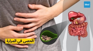 Magazine الحصى في المرارة