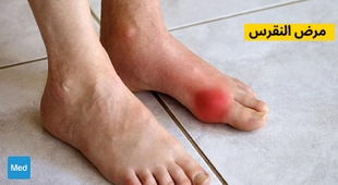 Magazine مرض النقرس - التشخيص والأسباب والعلاج