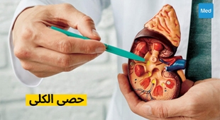 Makaleler حصى الكلى: الأسباب والأعراض والعلاج