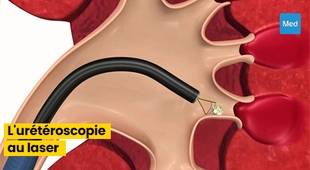Magazine Tout ce que vous devez savoir sur l'urétéroscopie au laser