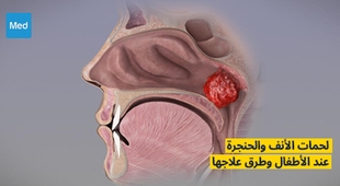 Magazine لحمات الأنف والحنجرة وطرق علاجها