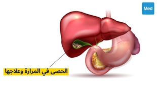 Magazine الحصى في المرارة وعلاجها
