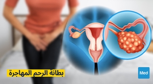 Magazine بطانة الرحم المهاجرة