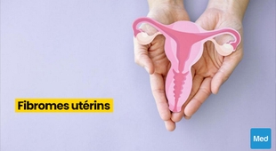 Magazine Fibromes utérins : définition, symptômes, diagnostic et traitement
