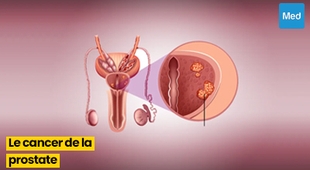 Makaleler Le cancer de la prostate