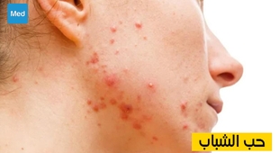 Makaleler حب الشباب