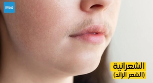 Makaleler فهم الشعرانية (الشعر الزائد)