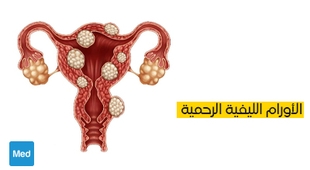 Magazine الأورام الليفية الرحمية: تعريف، أعراض، تشخيص وعلاج