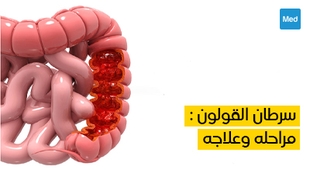 Magazine سرطان القولون : مراحله وعلاجه