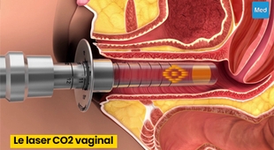 Magazine Le laser CO2 vaginal : une solution non invasive pour améliorer la santé et le bien-être intimes