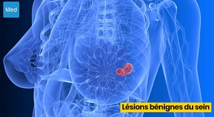 Magazine Lésions bénignes du sein