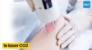 Makaleler Laser CO2 pour les taches pigmentaires et les cicatrices d’acné