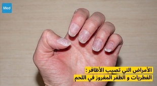 Magazine الأمراض التي تصيب الأظافر : الفطريات و الظفر المغروز في اللحم