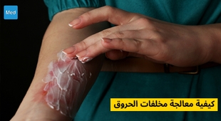 Magazine كيفية معالجة مخلفات الحروق 