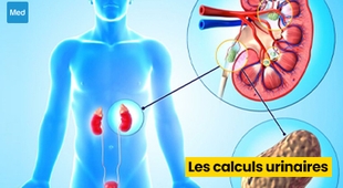 Makaleler Les calculs urinaires : causes, symptômes et traitements