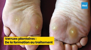 Magazine Verrues plantaires : De la formation au traitement