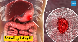 Makaleler القرحة في المعدة 