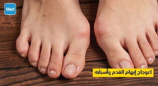 Magazine اعوجاج إبهام القدم وأسبابه 