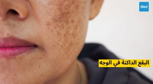 Magazine البقع الداكنة في الوجه