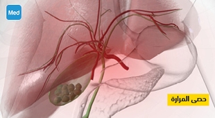 Magazine حصى المرارة