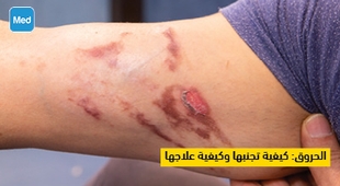 Magazine الحروق : كيفية تجنبها وكيفية علاجها 