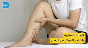 Magazine الوذمة اللمفاوية واحتباس السوائل في الجسم