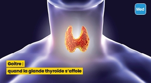 المجلة الطبية Goitre : quand la glande thyroïde s'affole