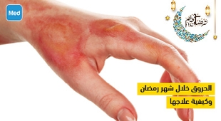Magazine الحروق خلال شهر رمضان وكيفية علاجها