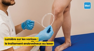 Magazine Lumière sur les varices : le traitement endoveineux au laser