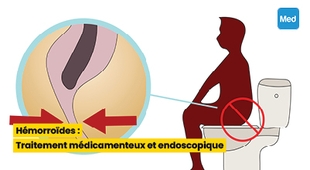 Magazine Hémorroïdes : Traitement médicamenteux et endoscopique