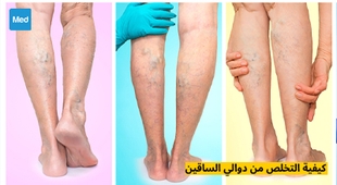 Magazine كيفية التخلص من دوالي الساقين