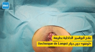 Magazine  علاج البواسير الداخلية بطريقة (technique de Longo)