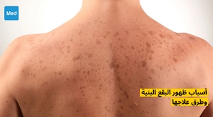 Makaleler أسباب ظهور البقع البنية وطرق علاجها