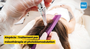 Makaleler Alopécie : Traitement par mésothérapie et photobiomodulation