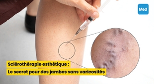 Magazine Sclérothérapie esthétique : Le secret pour des jambes sans varicosités