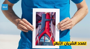 Makaleler تمدد الشريان الأبهر