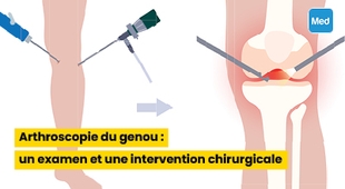 Makaleler Arthroscopie du genou : un examen et une intervention chirurgicale