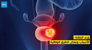 Magazine ورم المثانة : الأسباب وبعض الطرق الوقائية