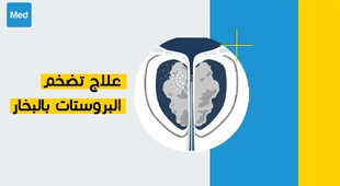 Magazine علاج تضخم البروستات بالبخار