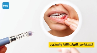 Magazine العلاقة بين التهاب اللثة والسكري
