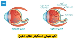 Magazine تأثير مرض السكري على العين