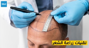 المجلة الطبية تقنيات زراعة الشعر 