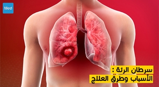 Makaleler سرطان الرئة : الأسباب وطرق العلاج